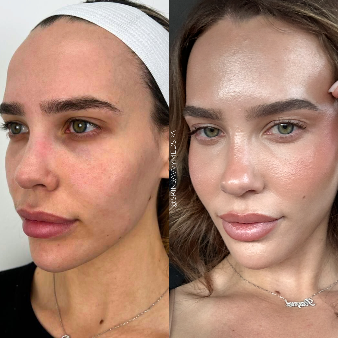 Microneedling | New Patient Promo