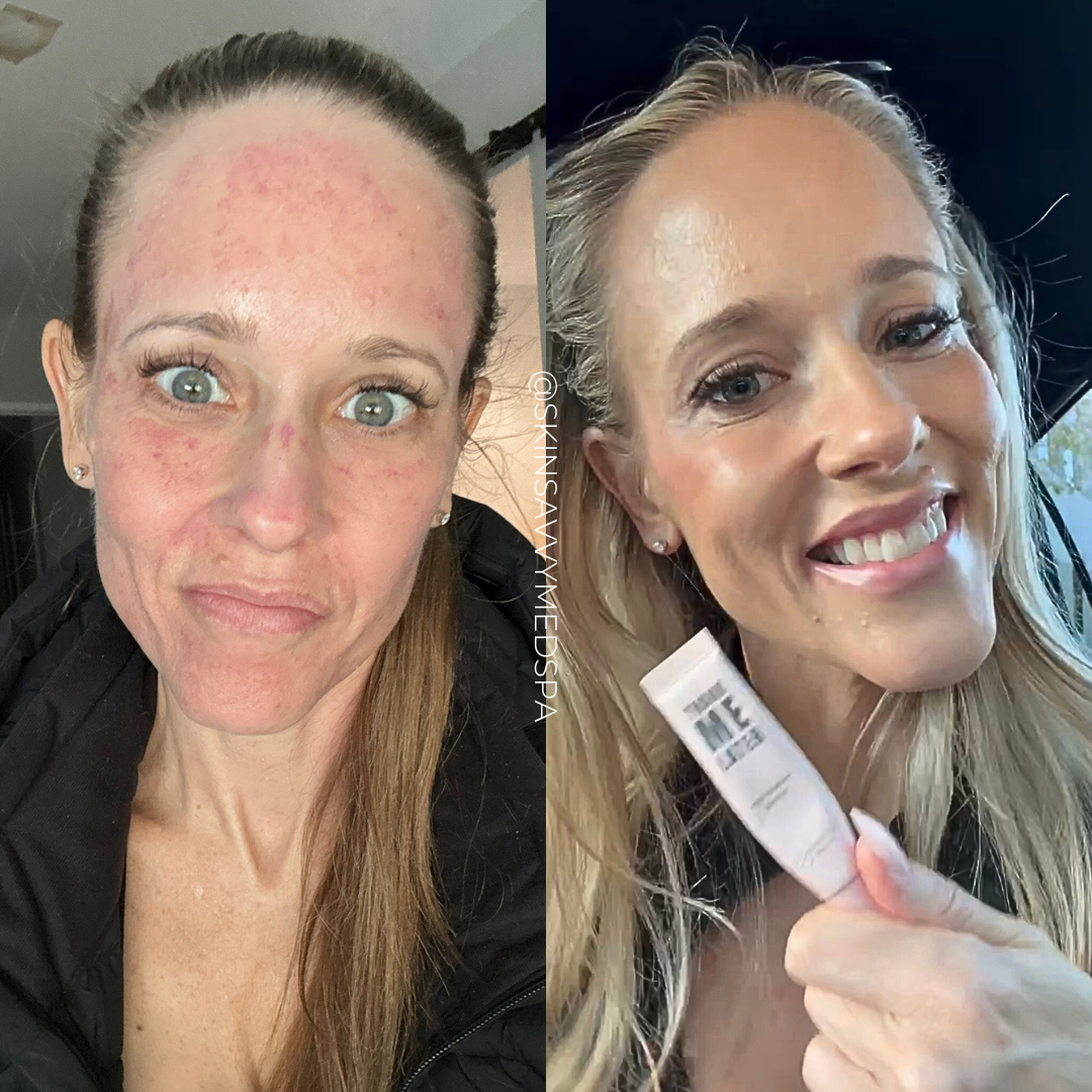 Microneedling | New Patient Promo