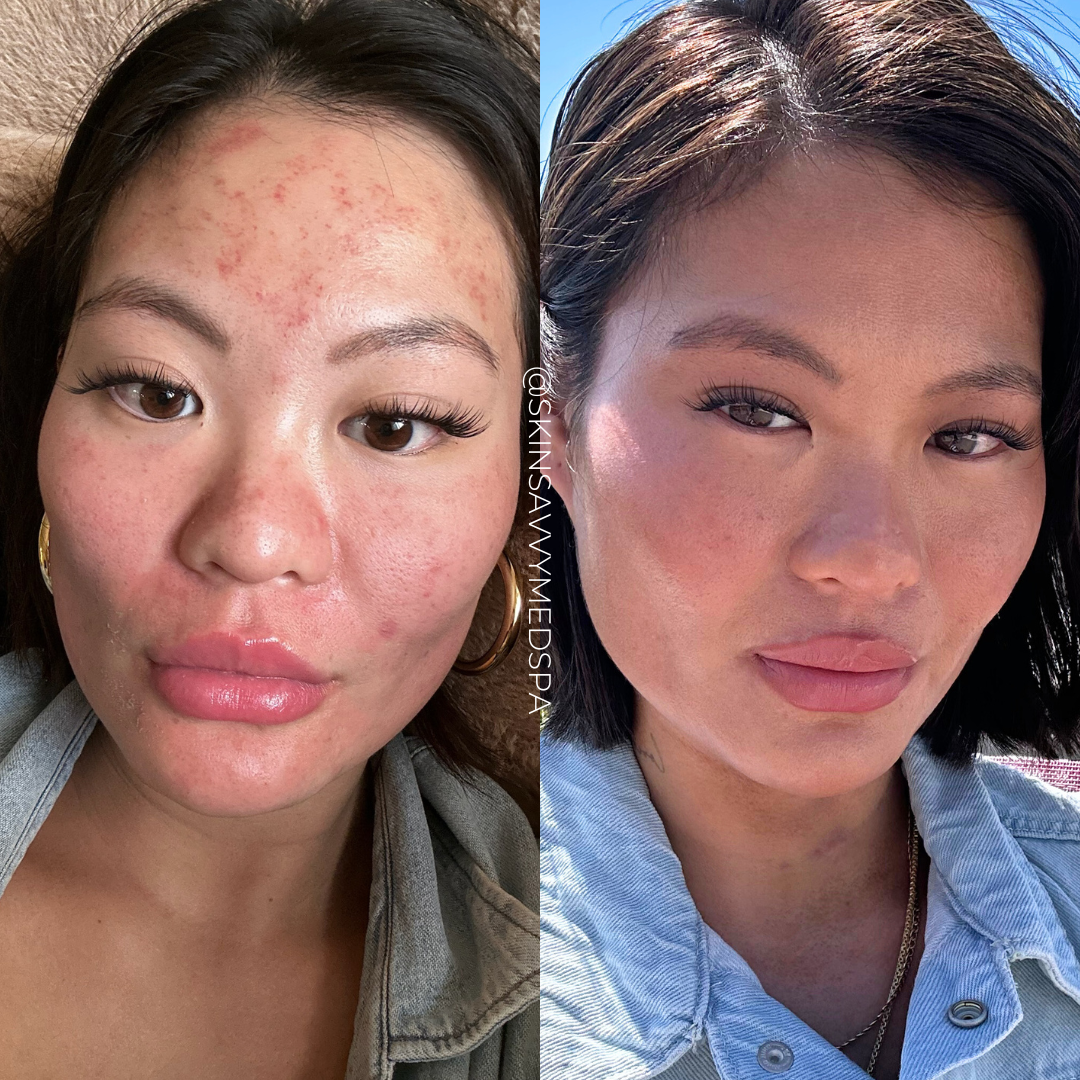 Microneedling | New Patient Promo