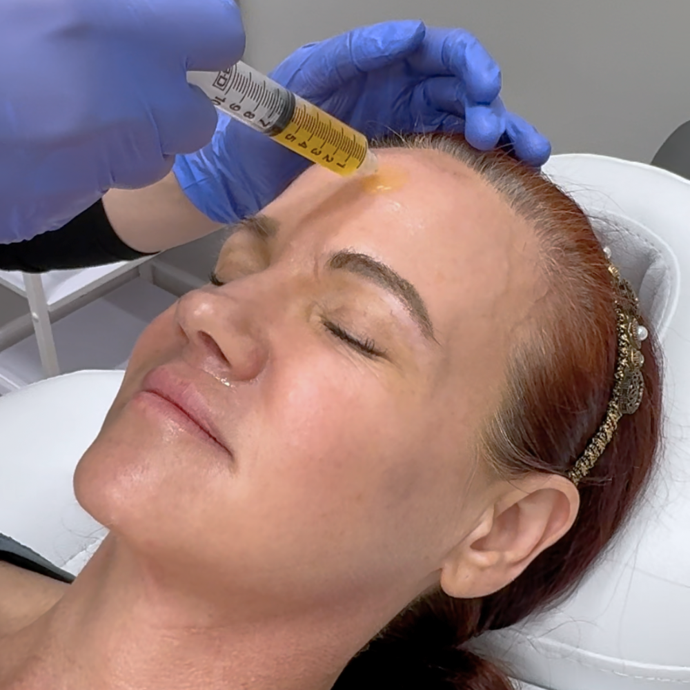Microneedling | PRP Microneedling