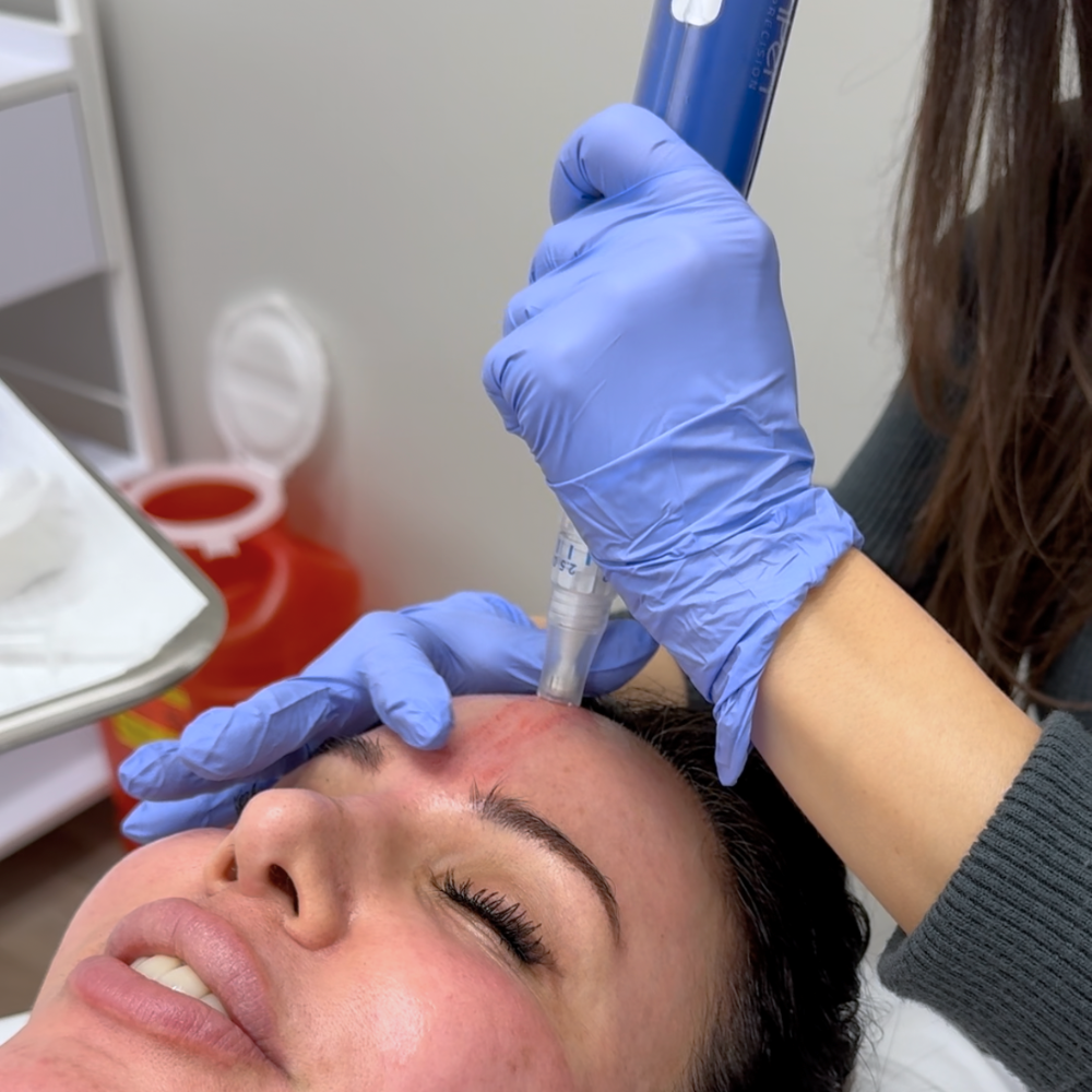 Microneedling | PRP Microneedling