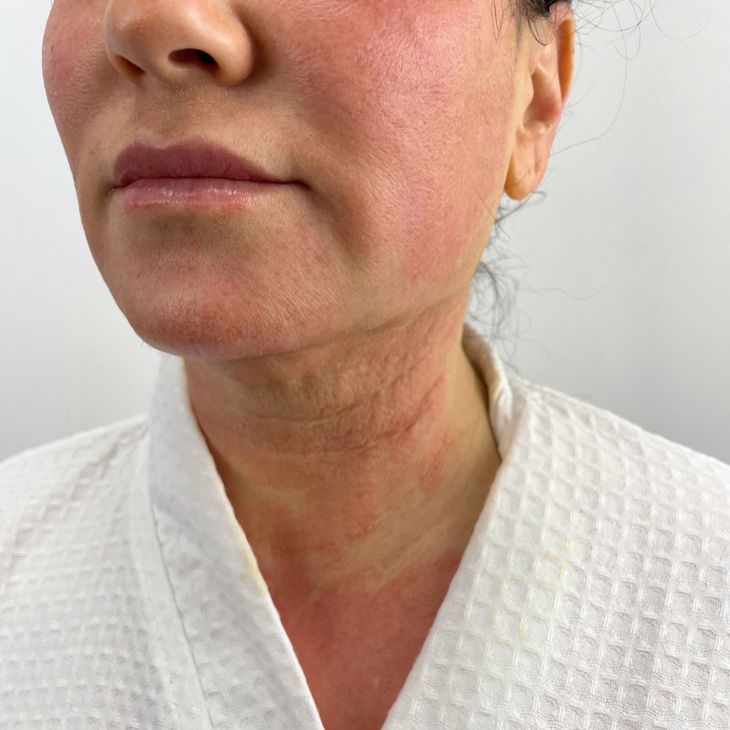 Skin Rejuvenation | Morpheus8 Series