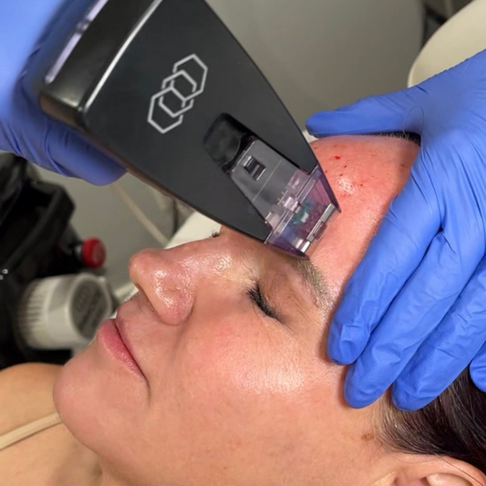 Morpheus8 Series| RF Microneedling