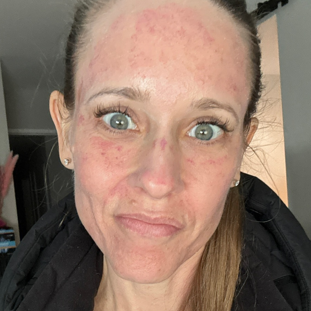 Microneedling | Skinpen®