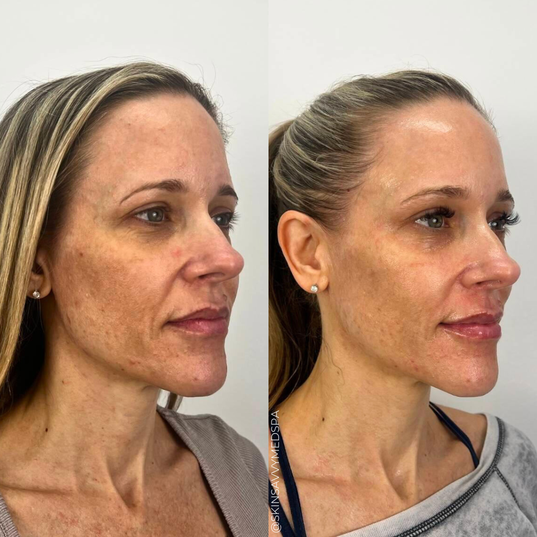 Microneedling | Skinpen®