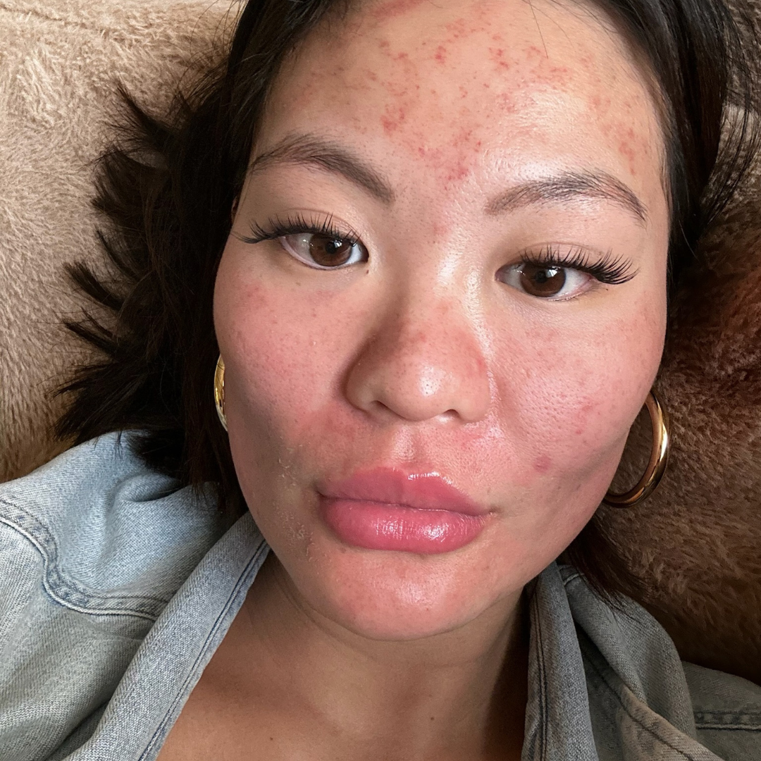 Microneedling | Skinpen®