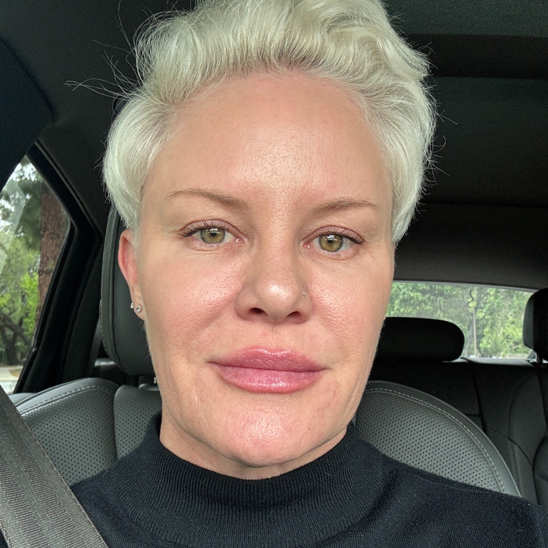 Microneedling | Skinpen®