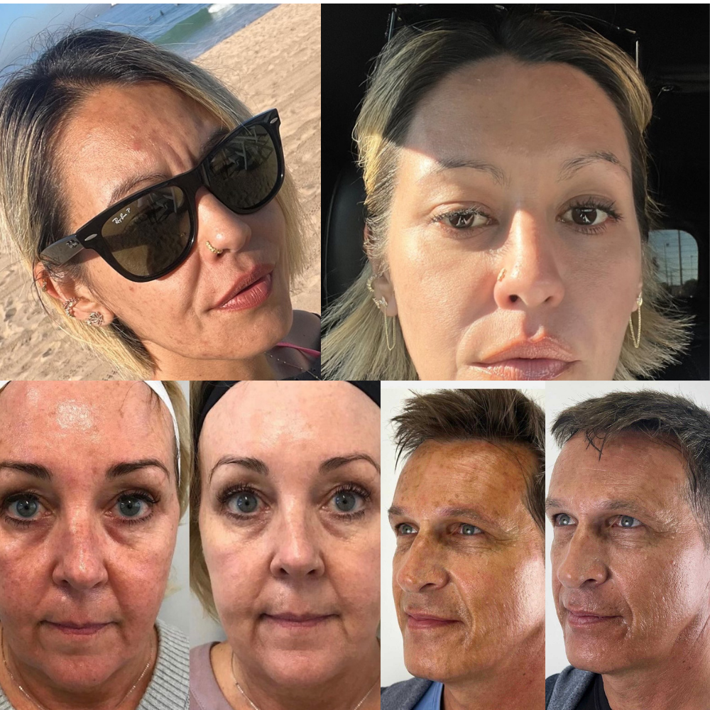 IPL Photofacial