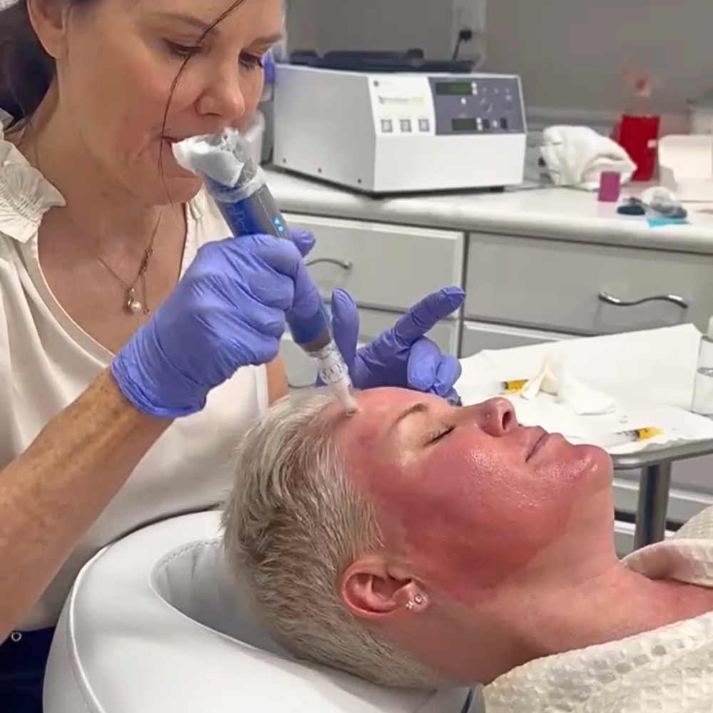 Microneedling | PRP Microneedling