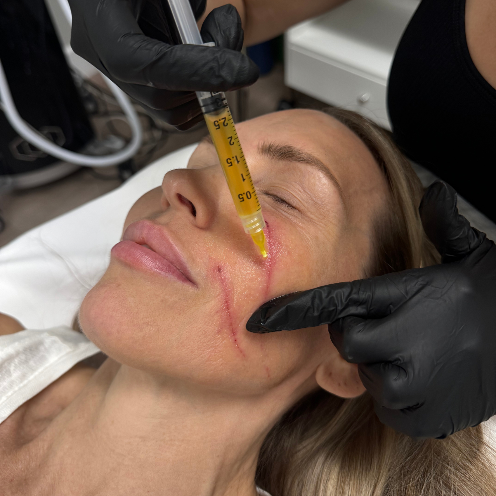 Microneedling | PRP Microneedling