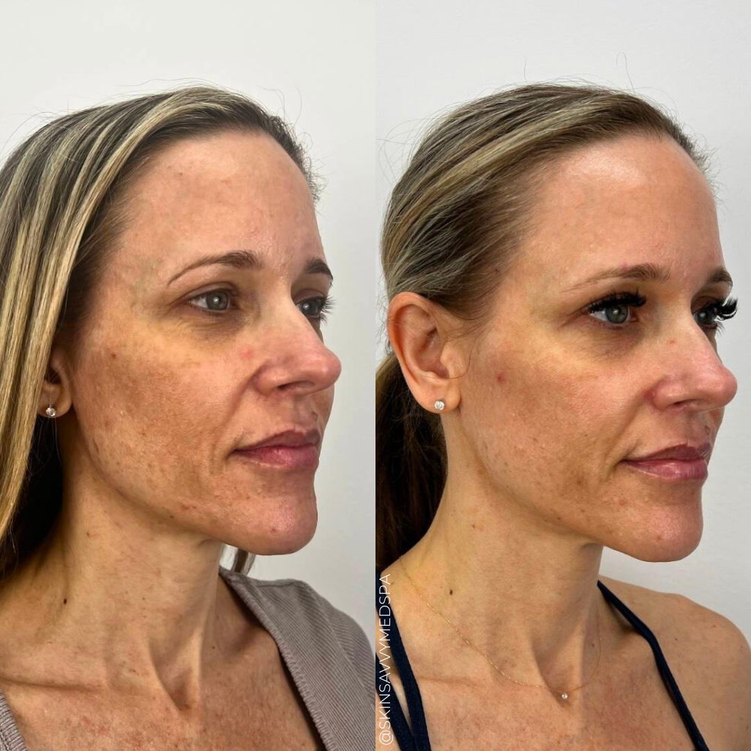 Microneedling | New Patient Promo