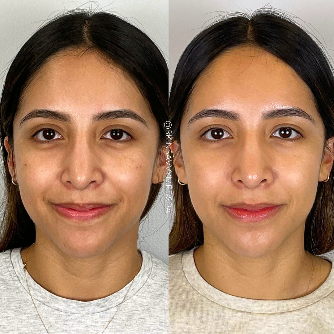 IPL Photofacial