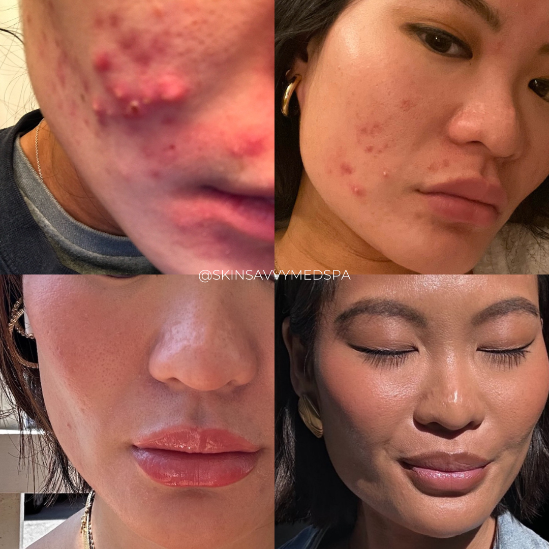 Microneedling | New Patient Promo