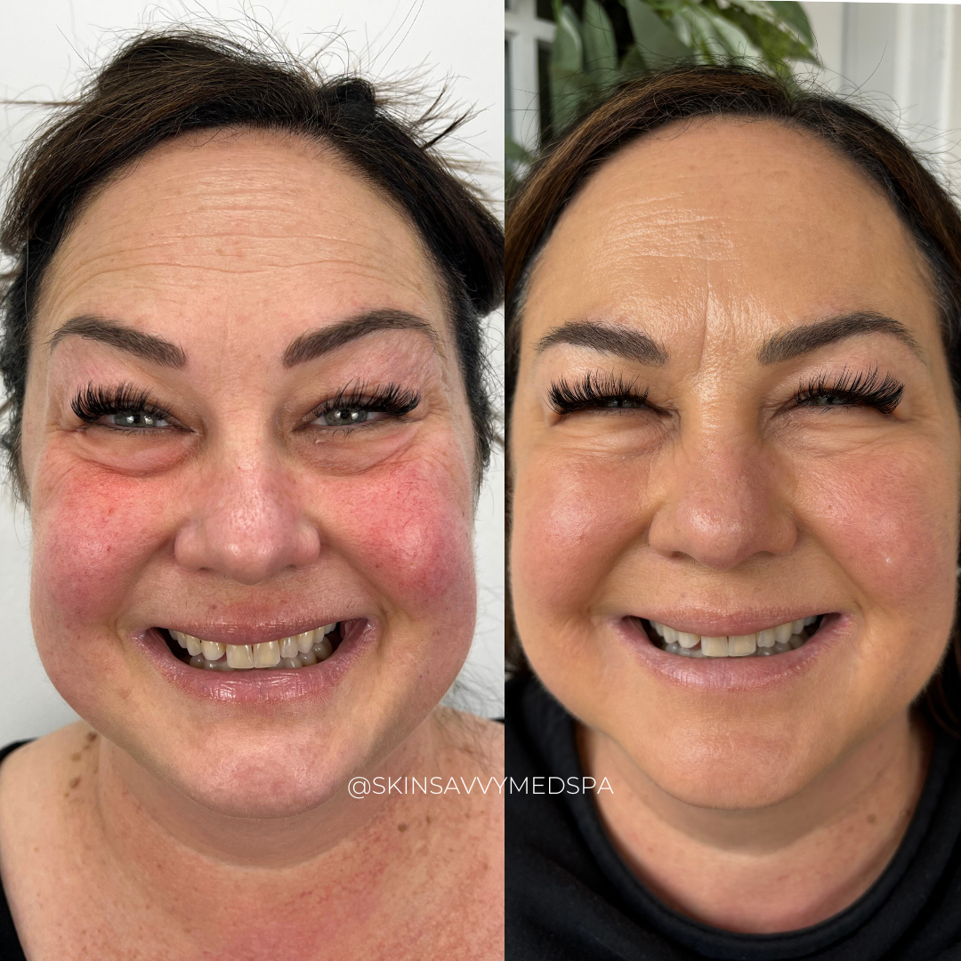 Microneedling | New Patient Promo