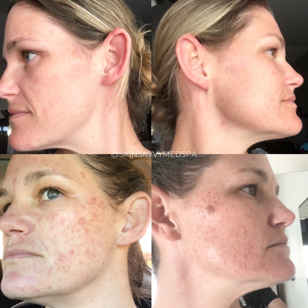 IPL Photofacial
