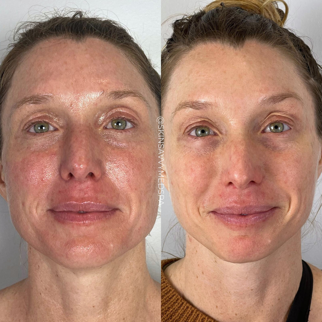 IPL Photofacial