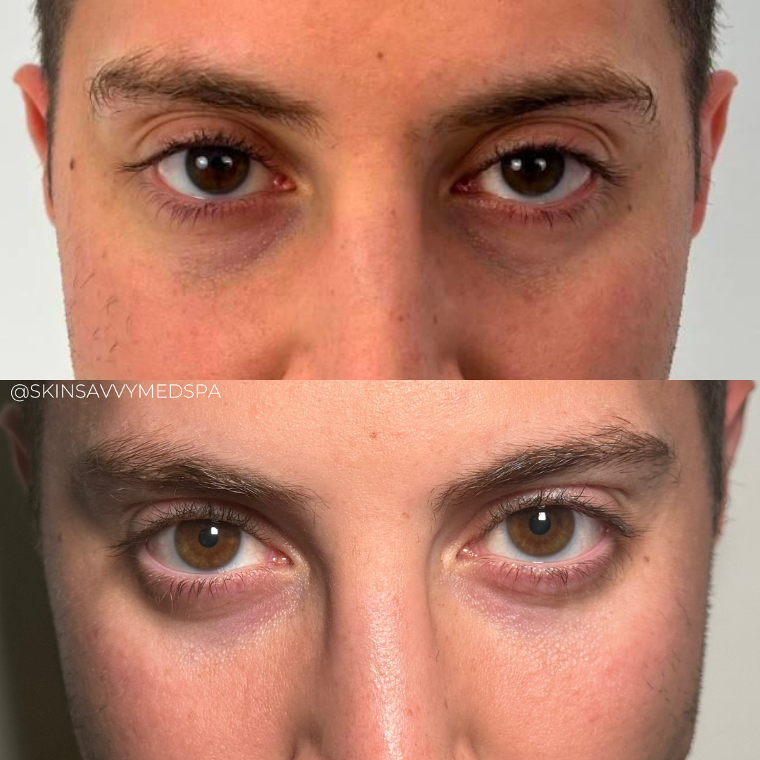 Under Eye Treatment | New Patient Offer