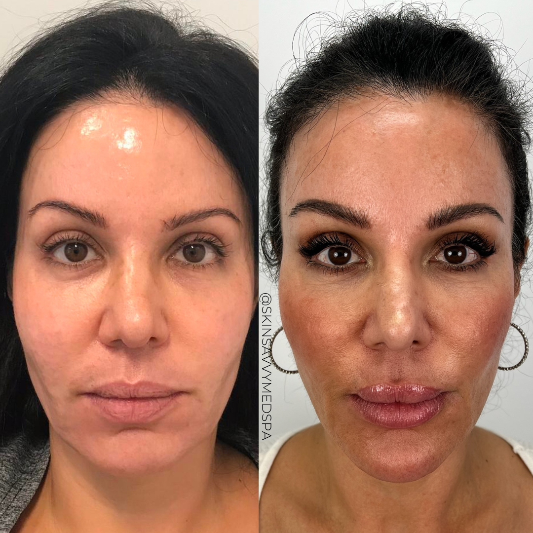 Microneedling | New Patient Promo