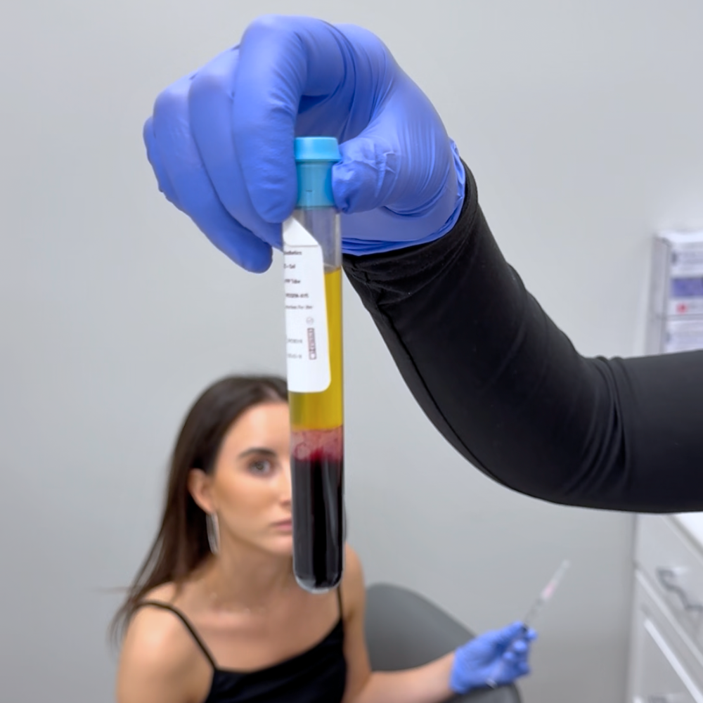 Microneedling | PRP Microneedling