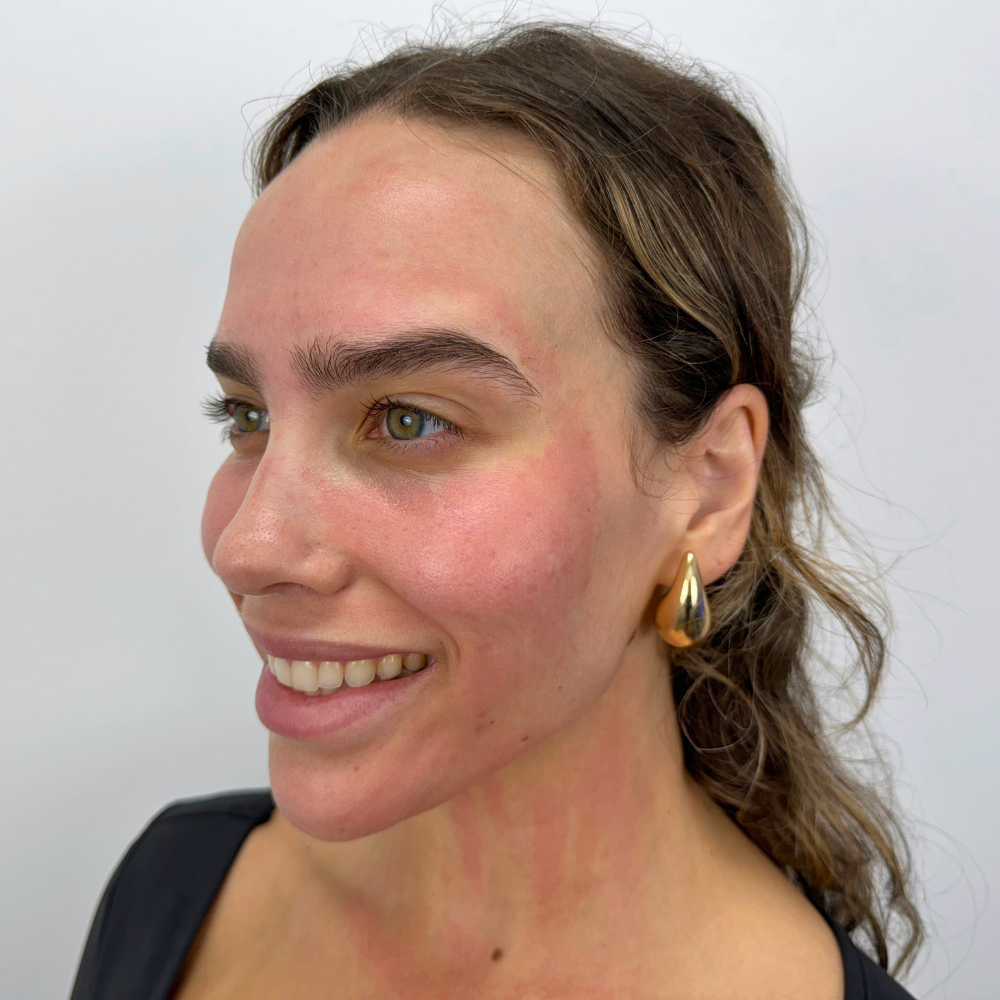 Microneedling | PRP Microneedling