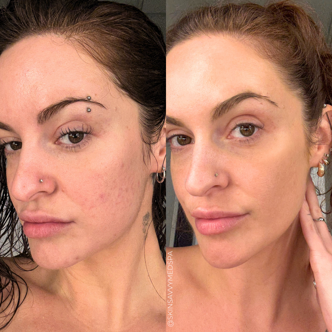 Microneedling | New Patient Offer