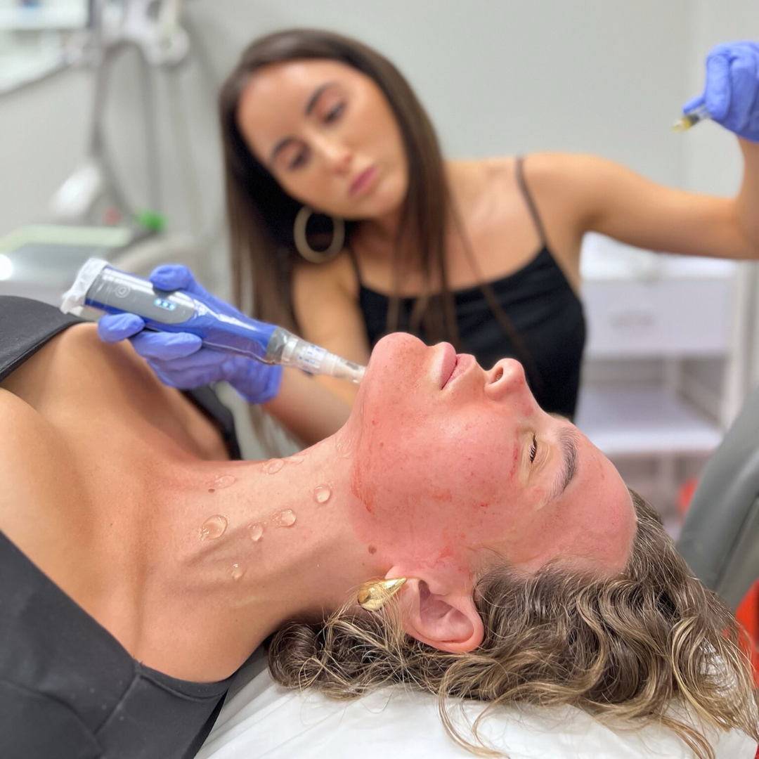Microneedling | New Patient Promo