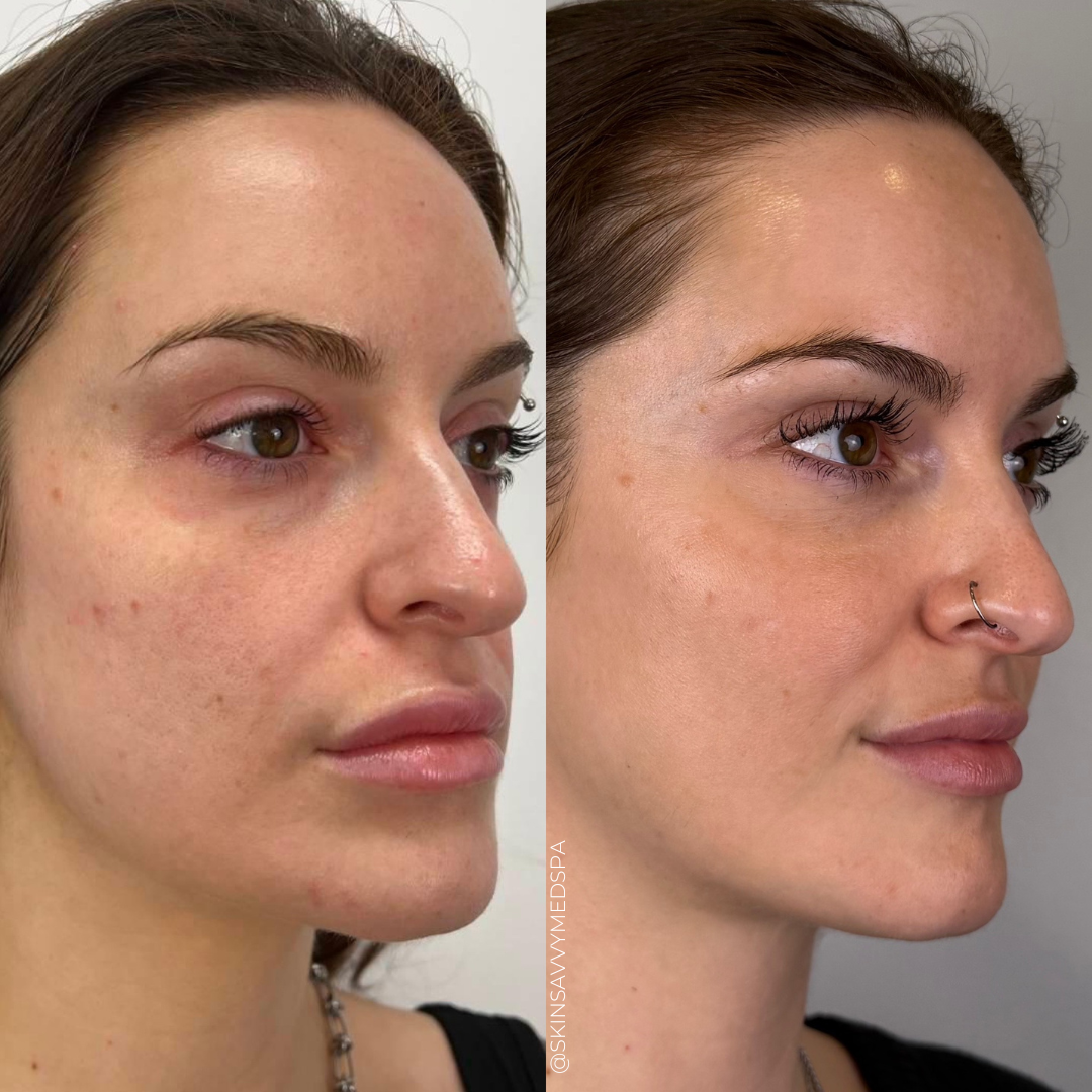 Under Eye Treatment | New Patient Offer
