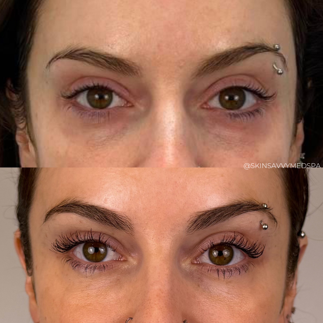 Under Eye Treatment | New Patient Offer