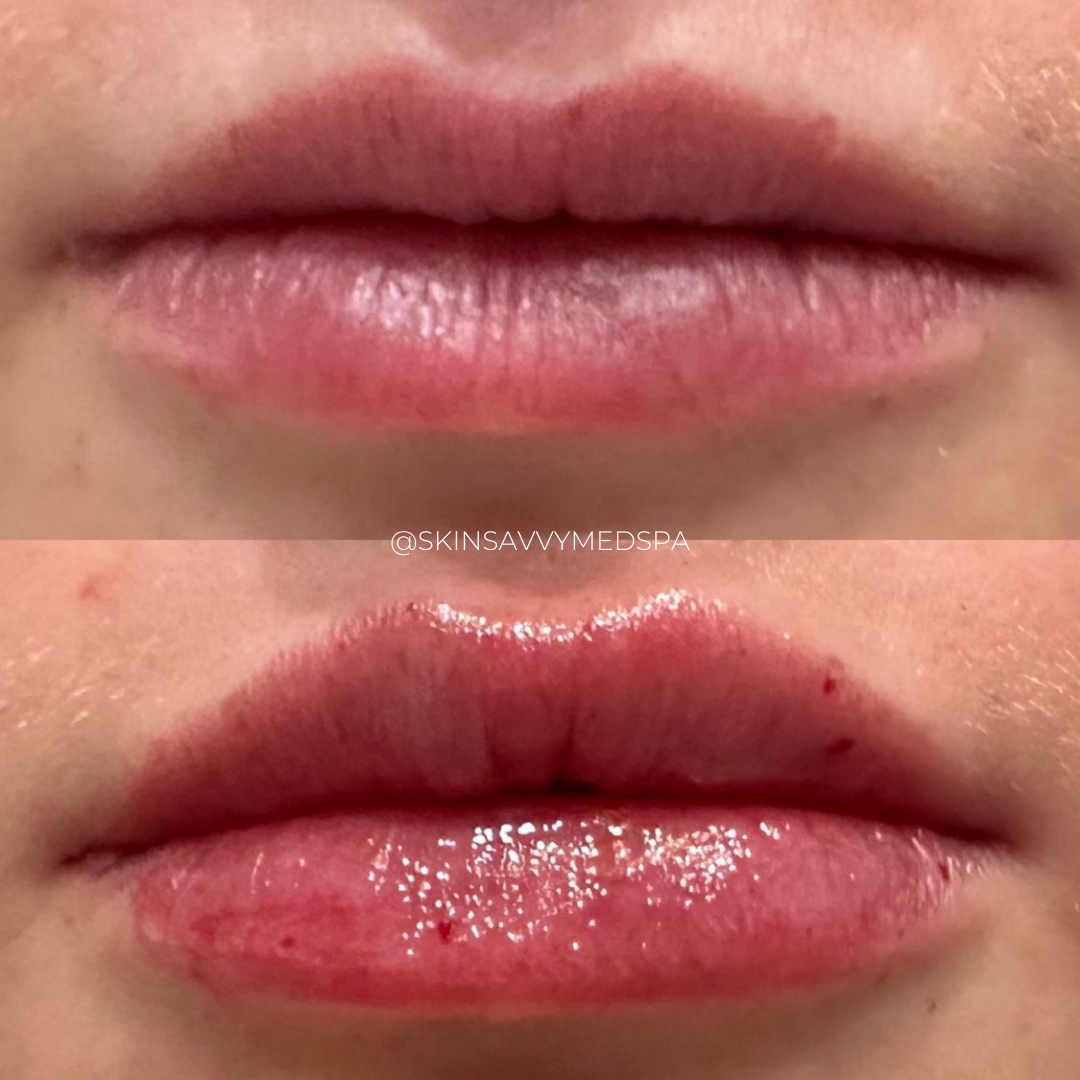 Custom Lips | New Patient Promo