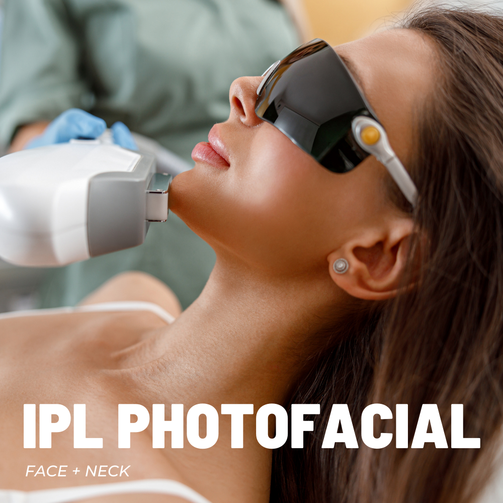 IPL PHOTOFACIAL FACE + NECK PACKAGE