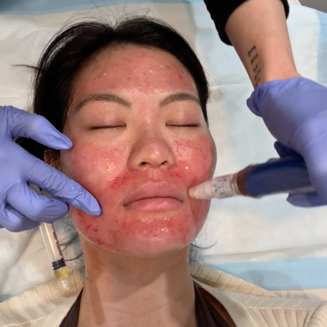 Microneedling | New Patient Promo