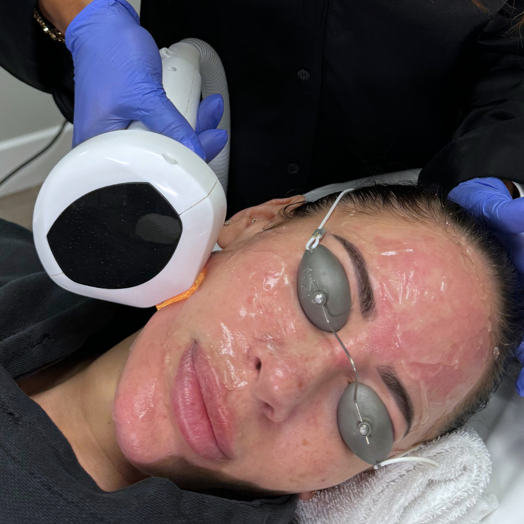 IPL Photofacial