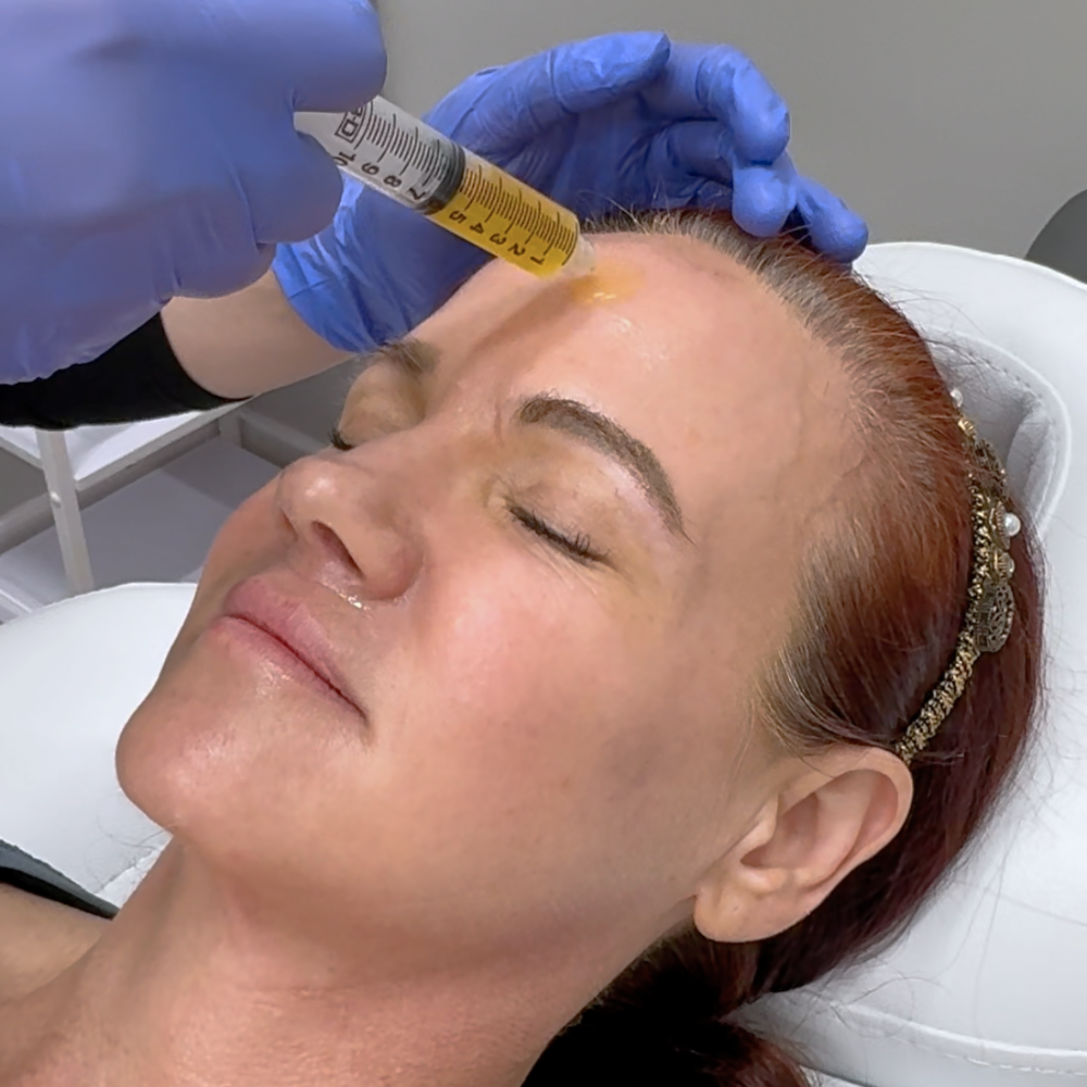 Black Friday | Microneedling With PRP