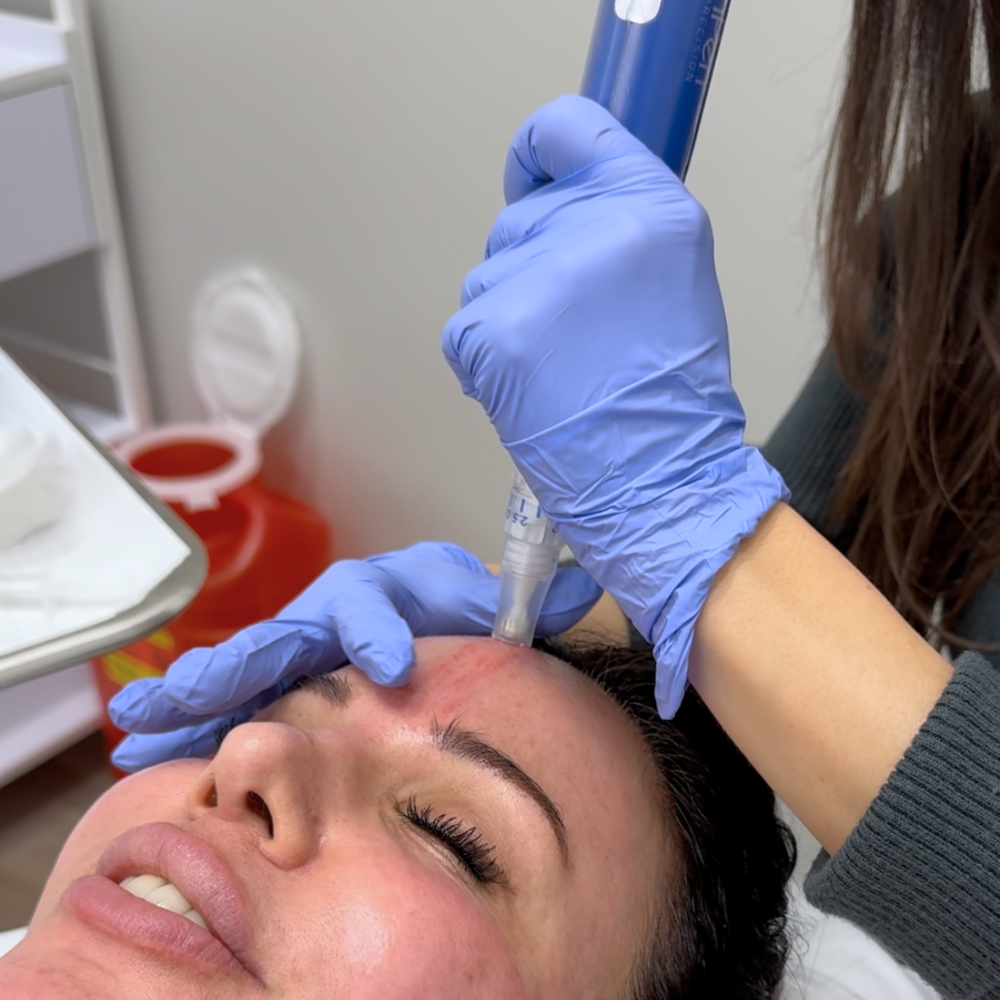 Black Friday | Microneedling With PRP