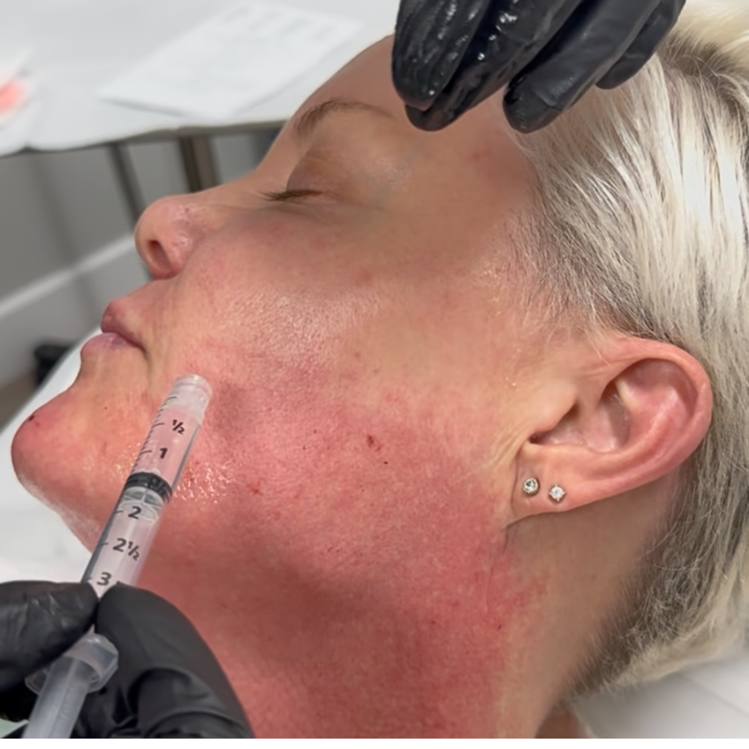 Microneedling | Skinpen®