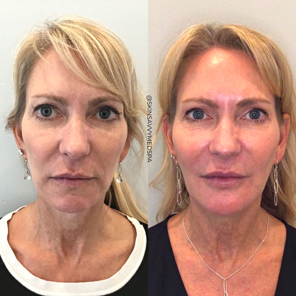 Sculptra | New Patient Promo