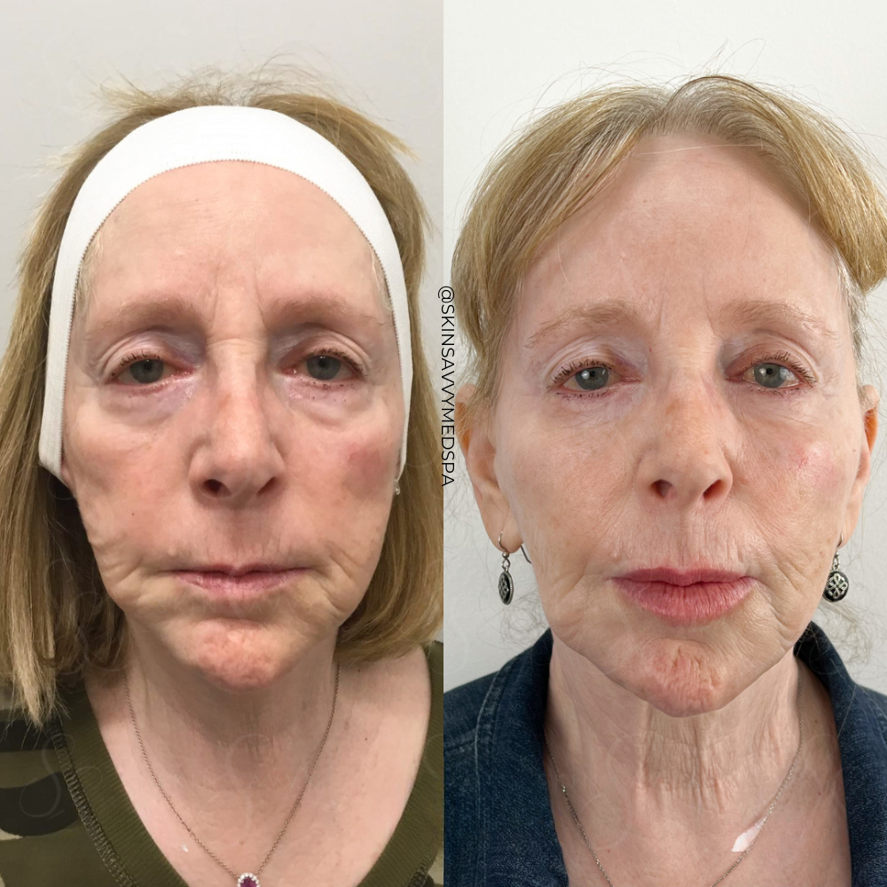 Sculptra | New Patient Promo