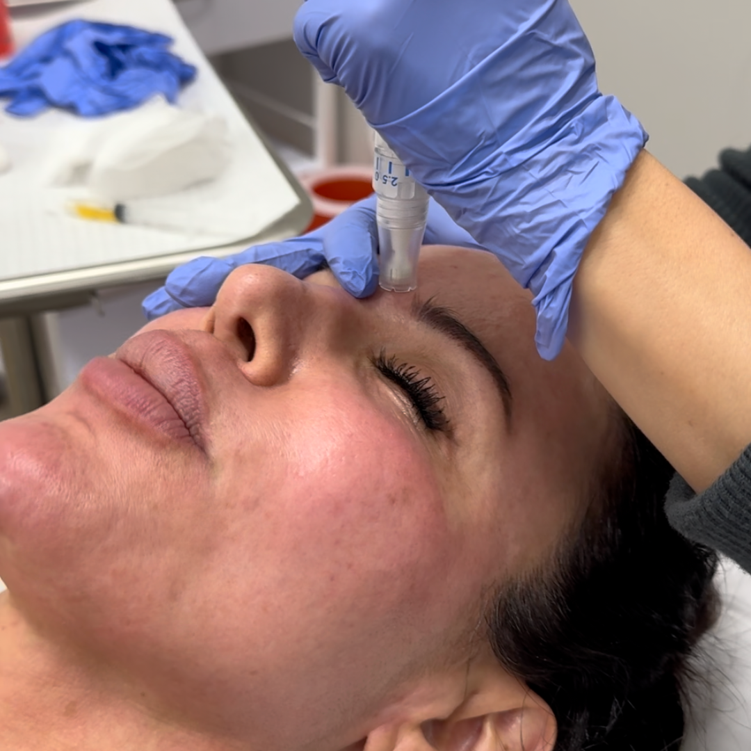 Microneedling | New Patient Promo