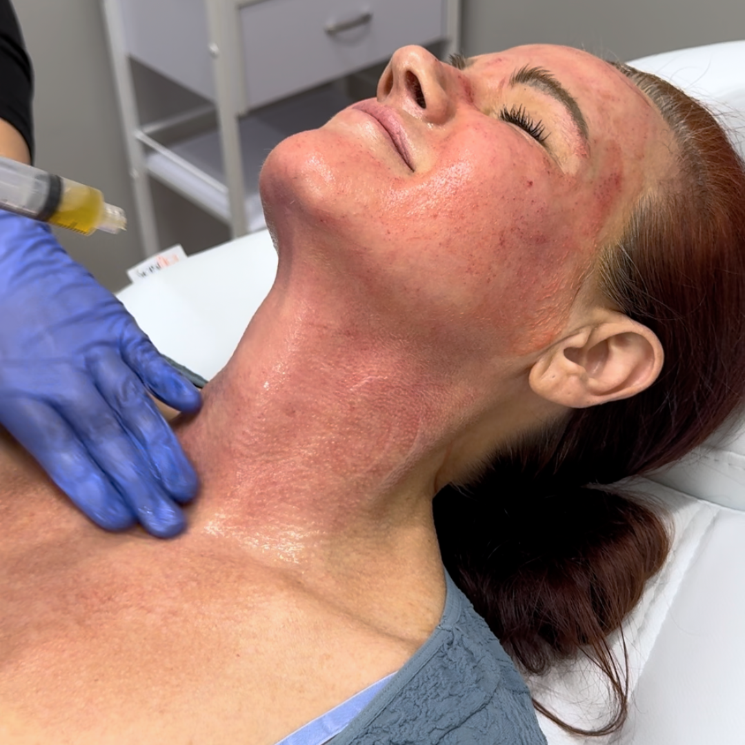 PRP Microneedling | New Patient Promo