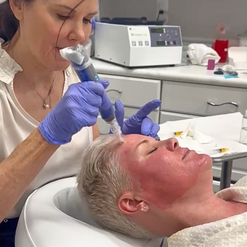 Black Friday | Microneedling With PRP