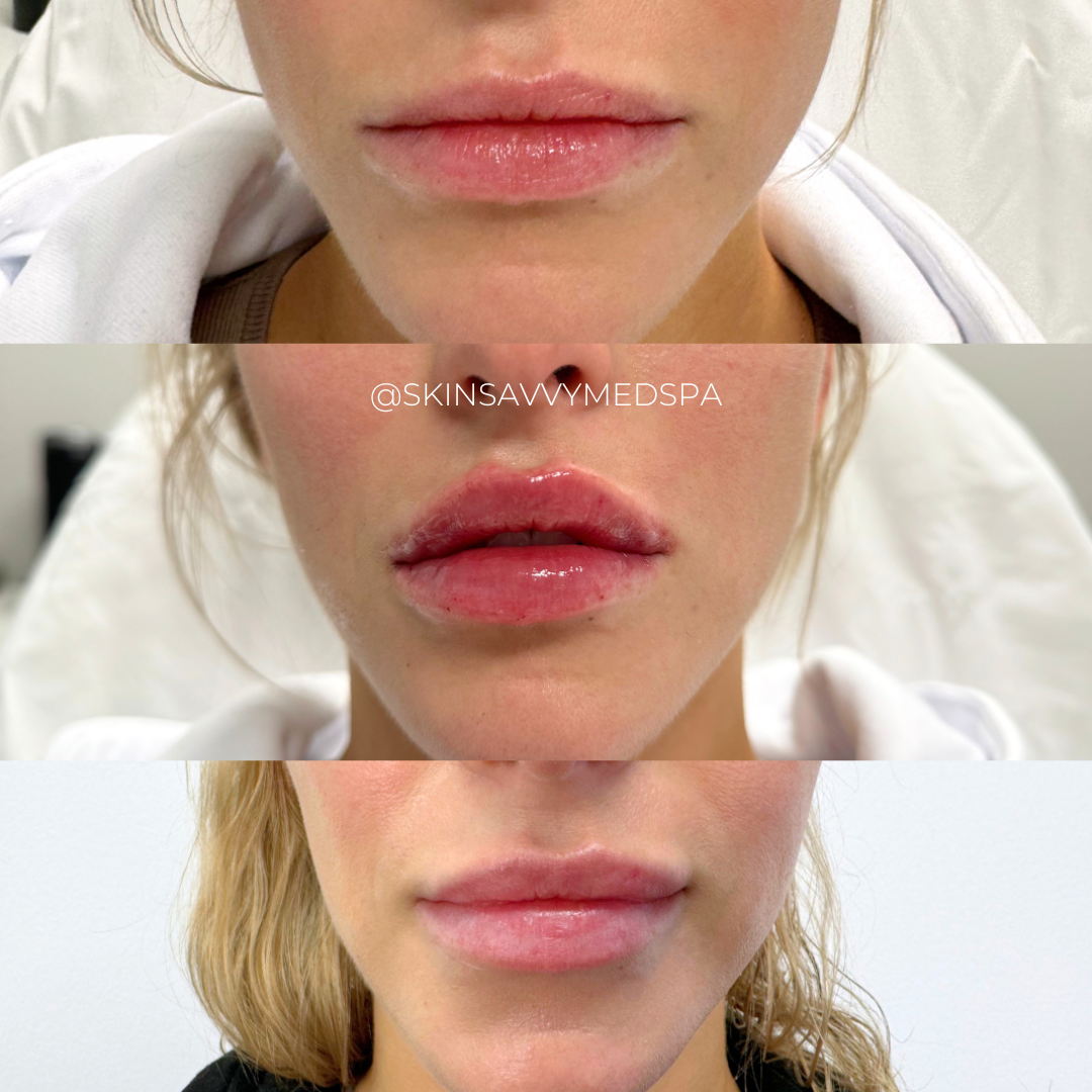 Custom Lips | New Patient Promo