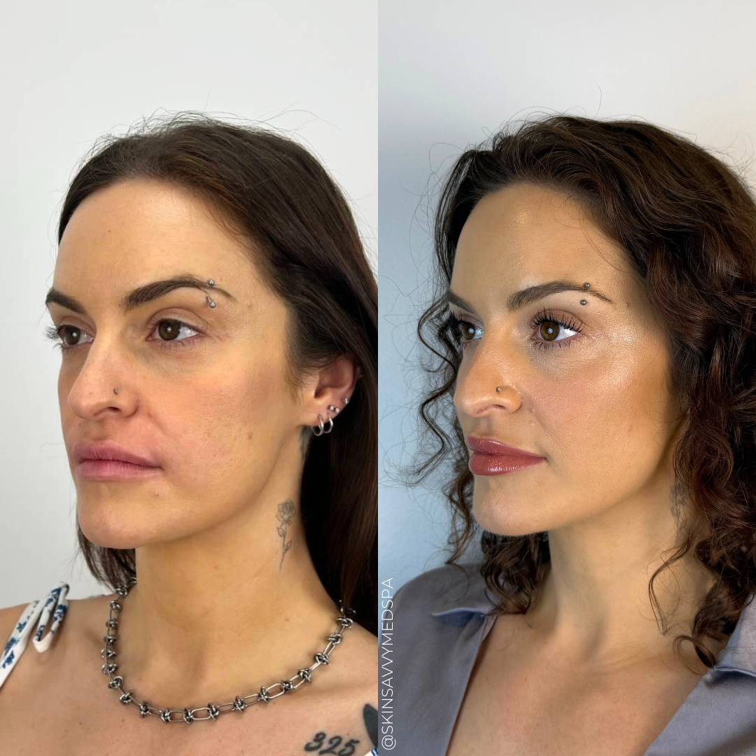 The Filler Flash Pack | Summer Offer