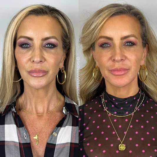 Under Eye Treatment | New Patient Offer