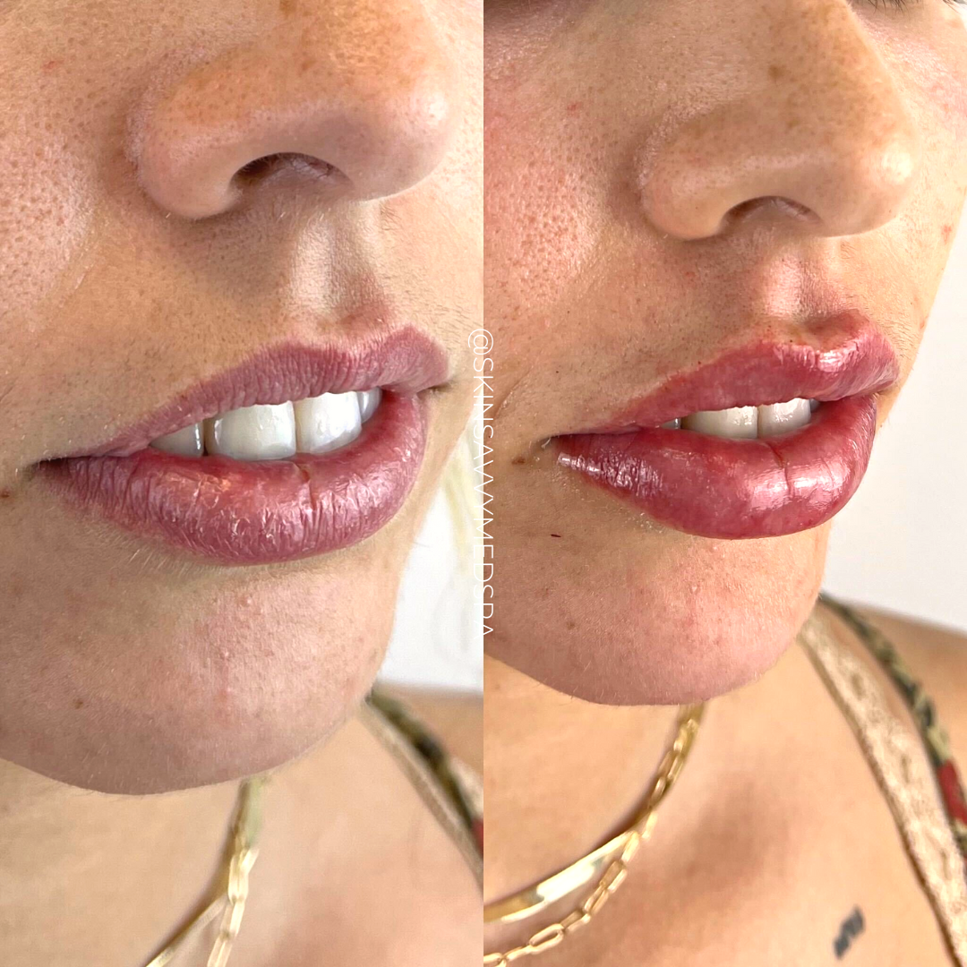 Custom Lips | New Patient Promo