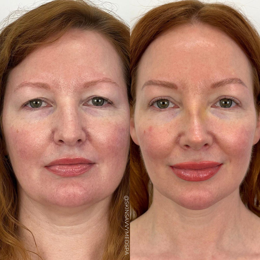 The Filler Flash Pack | Summer Offer