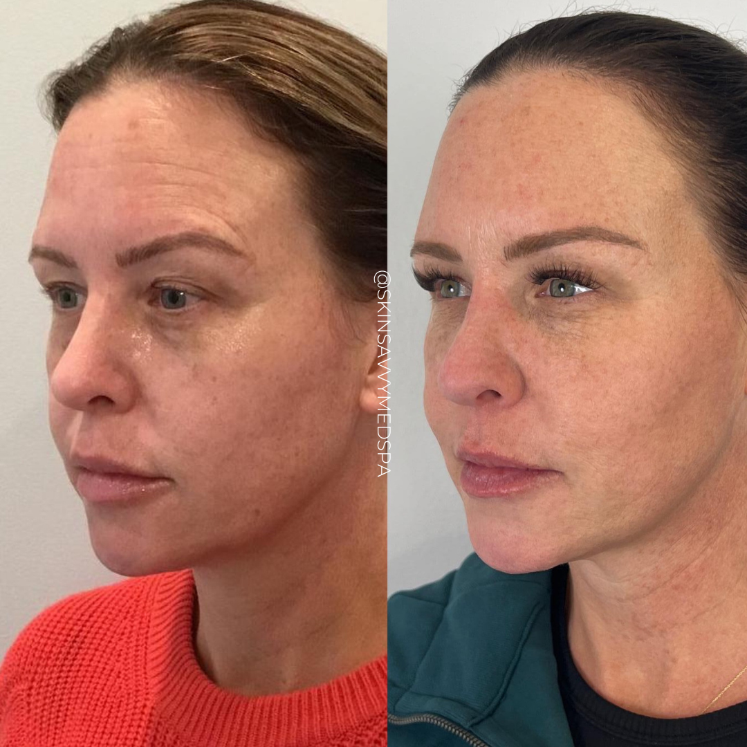 Under Eye Treatment | New Patient Offer