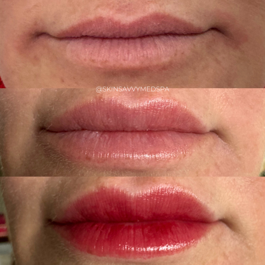 Custom Lips | New Patient Promo