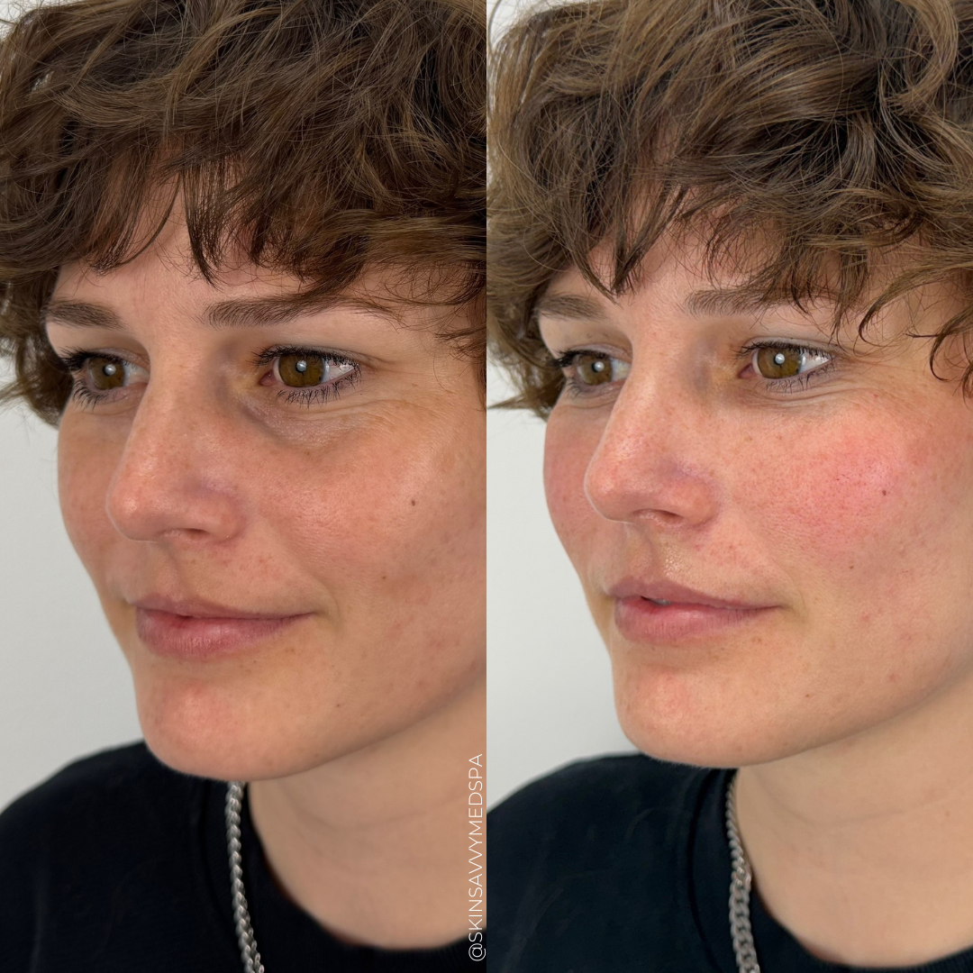 Under Eye Treatment | New Patient Offer