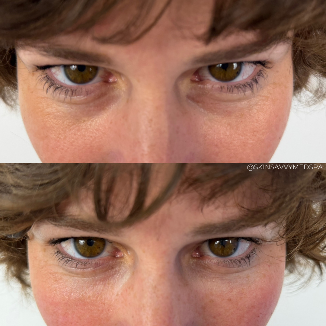 Under Eye Treatment | New Patient Offer