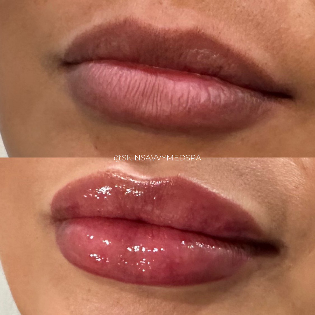 Custom Lips | New Patient Promo